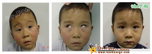 肌麻痹(右眼)长长 女 右眼上斜肌不全麻痹,原在位注视时,右眼为上斜眼