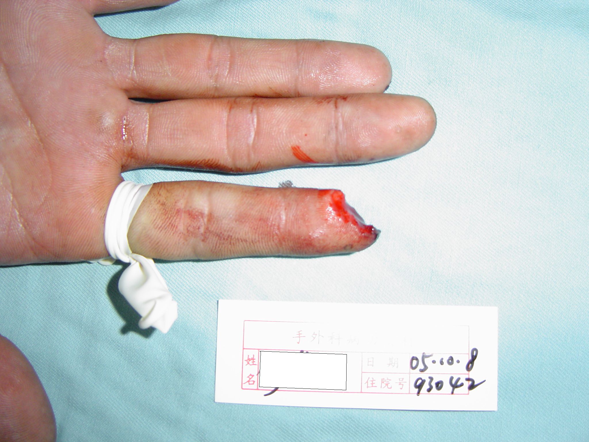 右食指指尖部分缺损再造