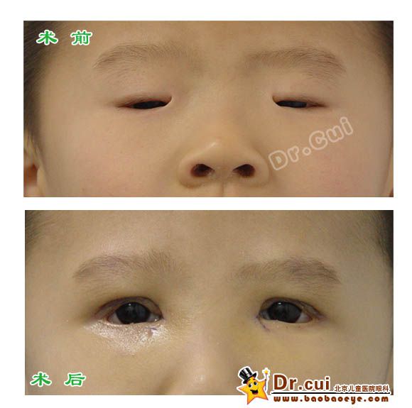 患儿先天性小睑裂综合症,双眼睑裂狭小, 上睑下垂 ,内眦间距宽;术后睑