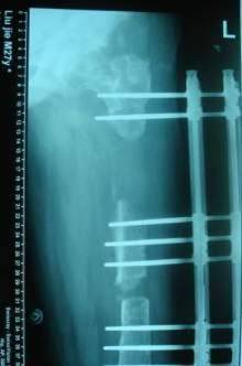 骨延长治疗髓内钉术后感染致股骨大段骨缺损