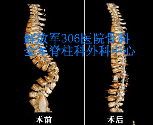 重度脊柱后凸畸形病例-3