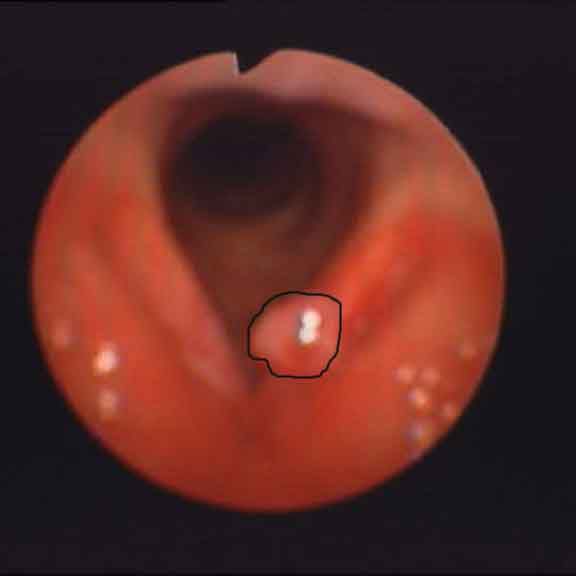 视频喉镜下声带息肉切除术附照片
