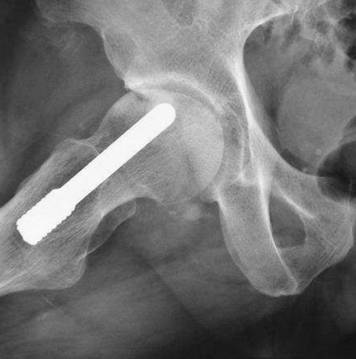 早期股骨头坏死"保头"治疗方法的评析系列5-----微创钽棒支.