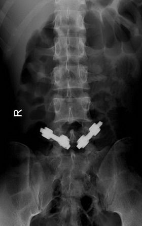 年轻患者腰5峡部裂手术方式