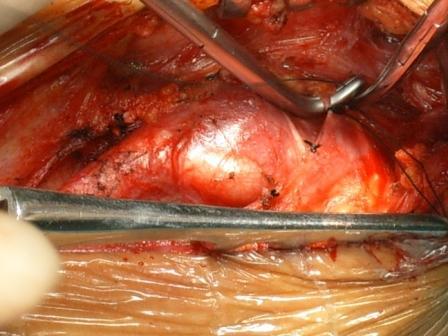 shamblin三级颈动脉体瘤的手术切除