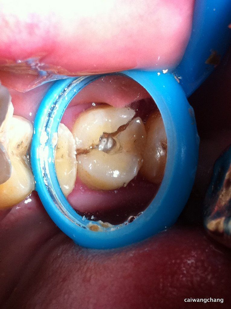 牙劈裂修复病例