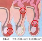 小儿腹股沟斜疝_小儿疝气_治疗方法_ 好大夫在线