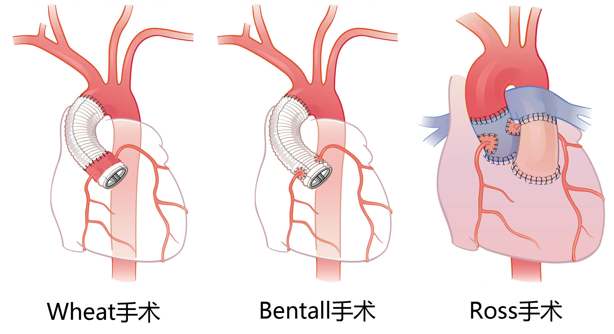 多数医生采取的方法是植入机械瓣或生物瓣(支架生物瓣或无支架生物瓣)