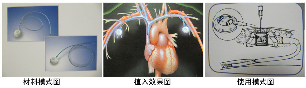 小儿静脉输液港植入术