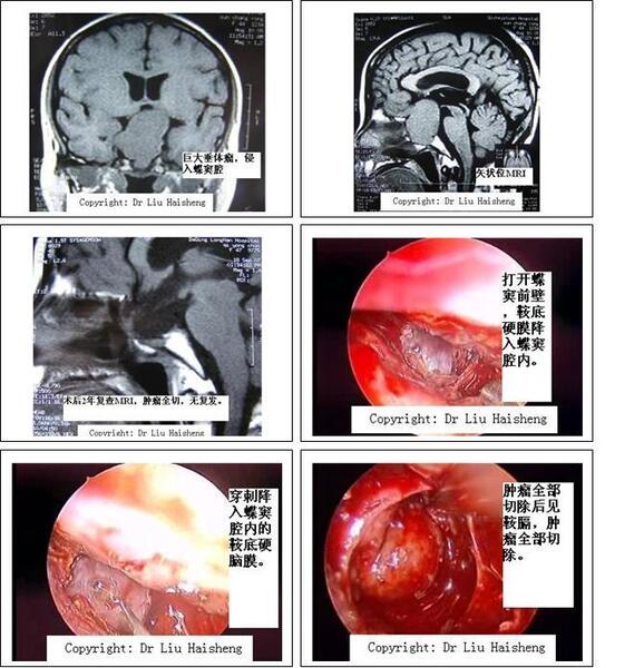 巨大型垂体瘤内镜经鼻手术切除病例,肿瘤侵入蝶窦腔,切除肿瘤后清晰