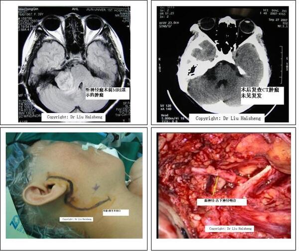 一例 听神经瘤 术后 面瘫 病人,行面神经 舌下神经吻合手术,舌下神经