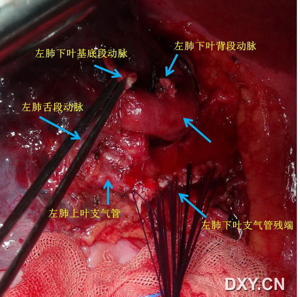 肺癌手术切除图片