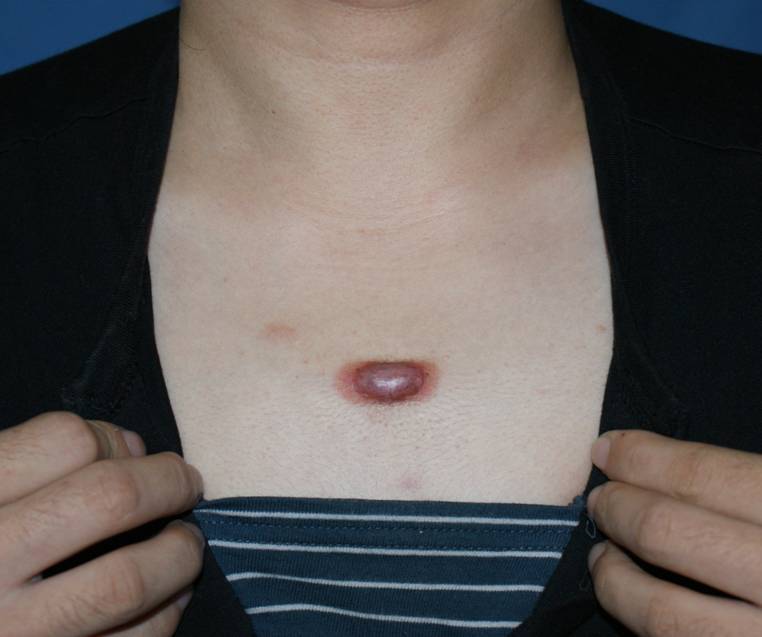 胸部瘢痕疙瘩治疗前后对比
