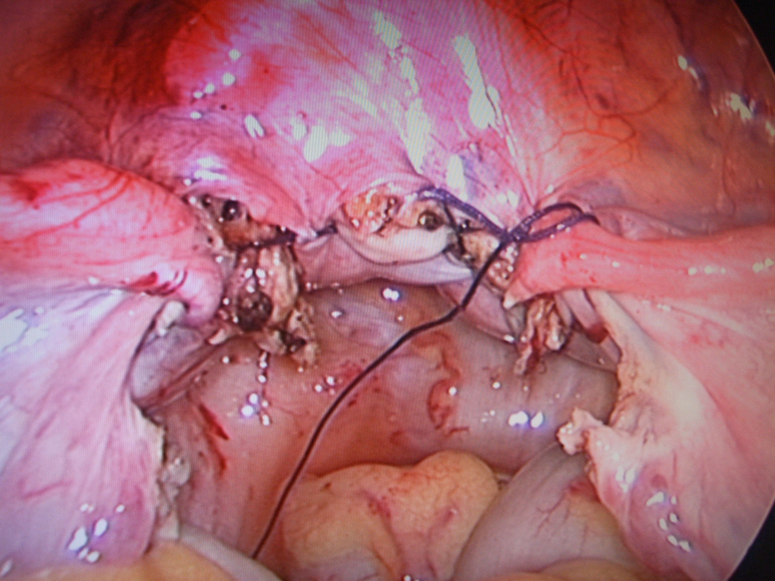 腹腔镜下子宫切除术 双侧圆韧带阴道残端悬吊术后的情形