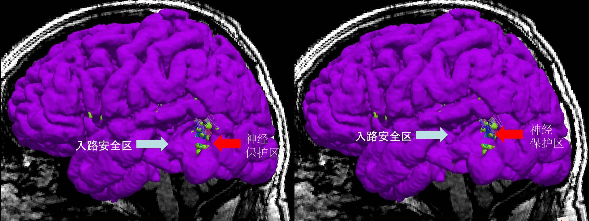 纤维的缺点,可以显示颅脑功能区 肿瘤 和重要传导束的空间关系和位置