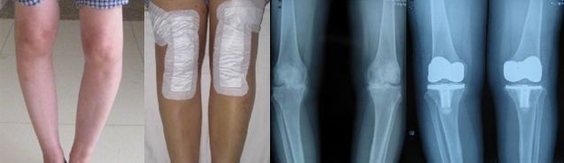 膝关节置换术后康复指导