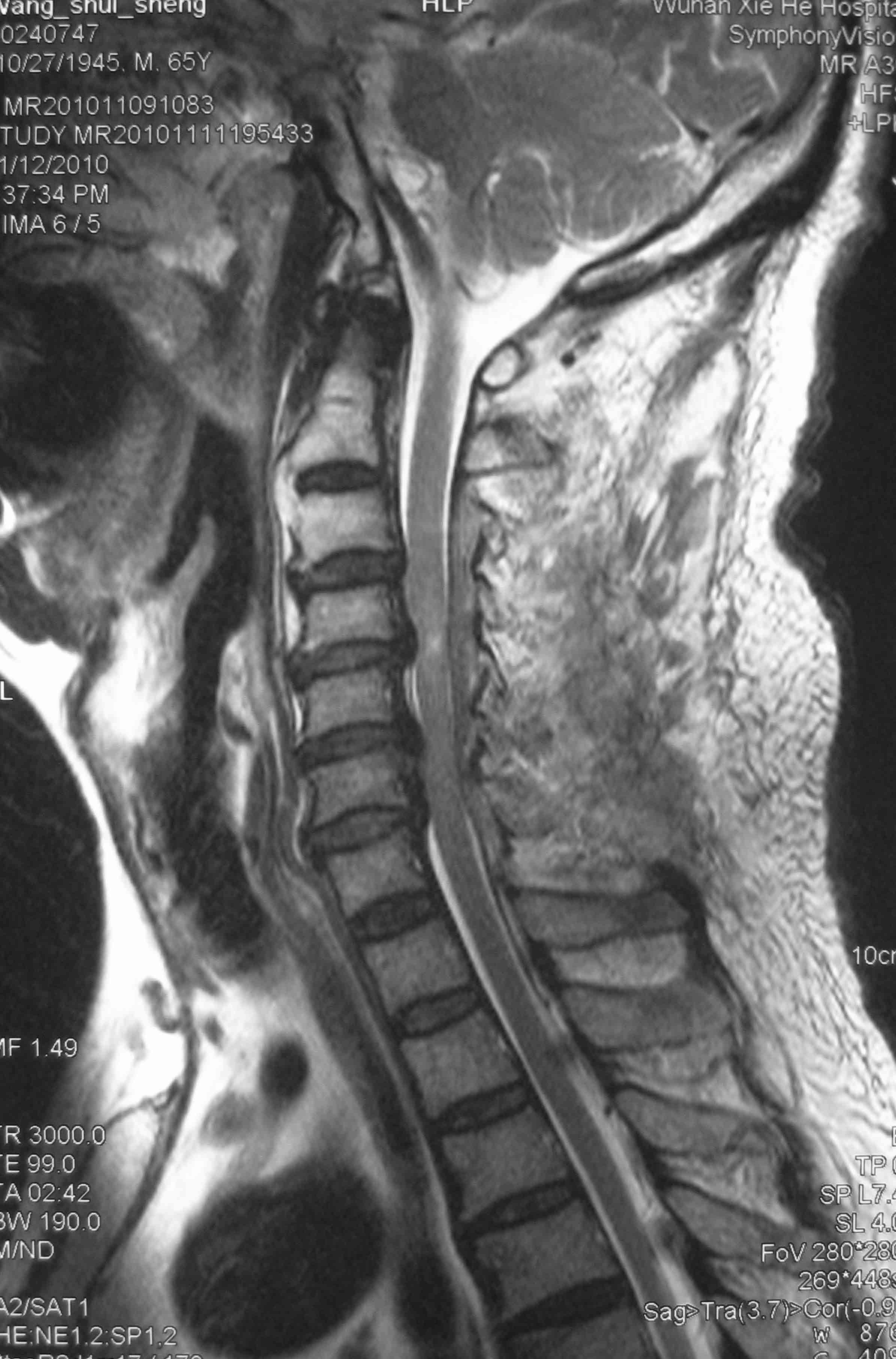 颈椎 韧带 钙化/术后磁共振显示脊髓压迫解除