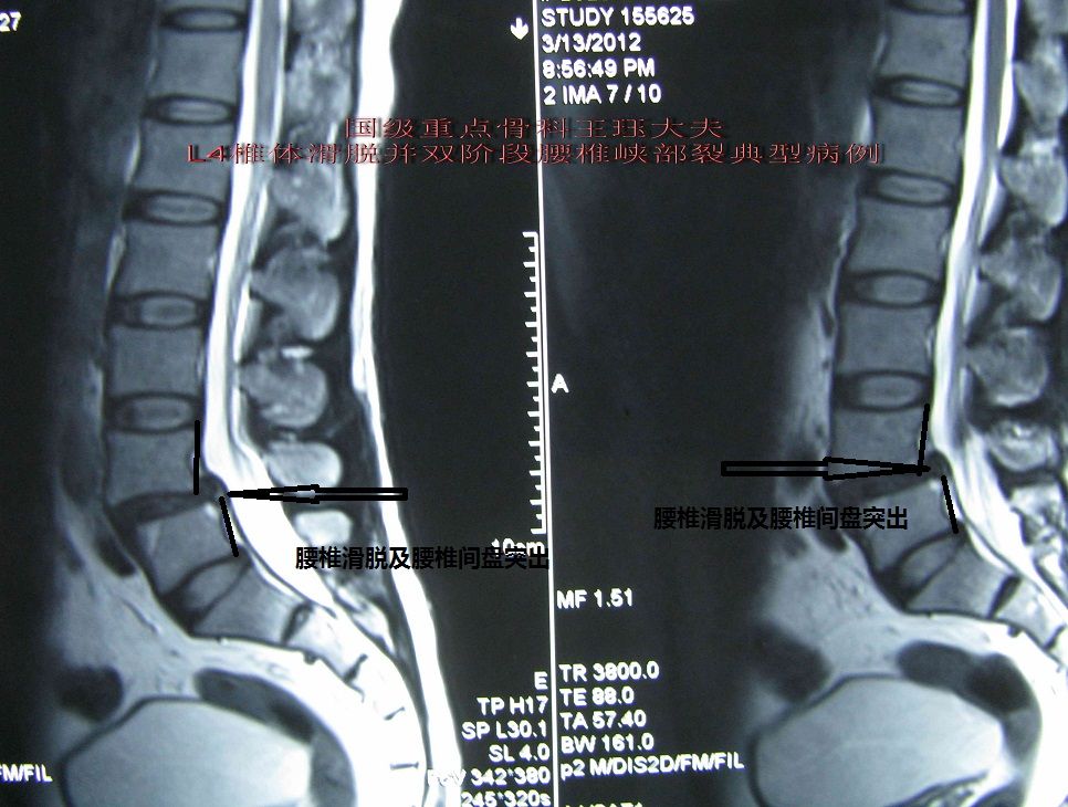 病例4:一例特殊腰椎滑脱病例---双椎体峡部裂,完全复位解除病痛