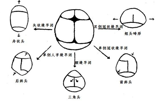 婴儿头型异常警惕颅缝早闭需尽早明确诊断争取早期治疗