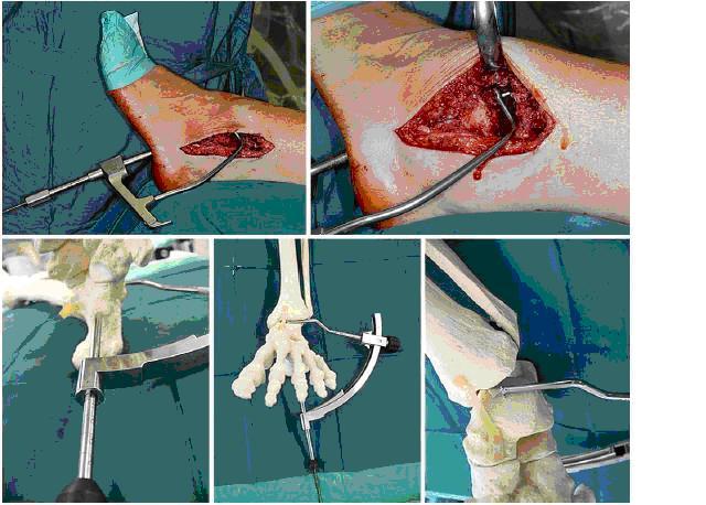 胫骨acl导向器在踝关节融合术中的应用