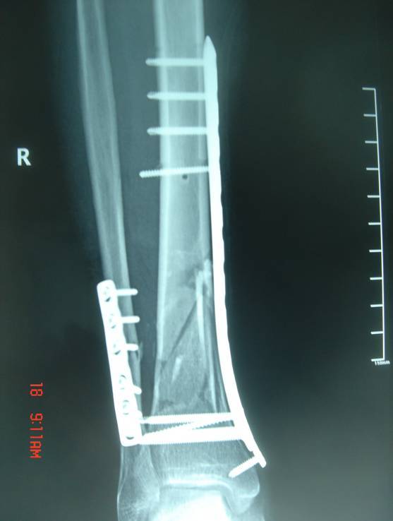 一患者实施经皮微创锁定钢板内固定治疗胫腓骨远端复杂粉碎性骨折手术