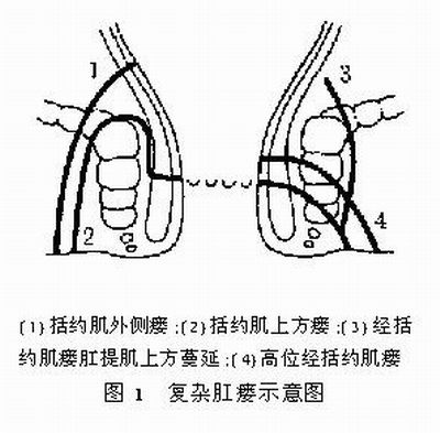 低位复杂性瘘:   按照 1975 年全国首届肛肠学术会议制订的肛瘘统一