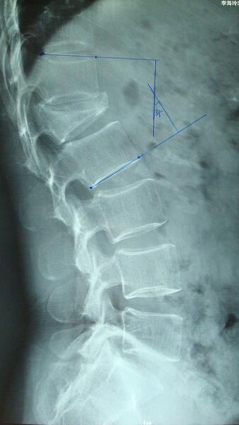 脊柱陈旧骨折后凸畸形截骨矫形术病例
