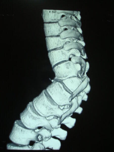 先天性脊柱侧弯(半椎体畸形)病例