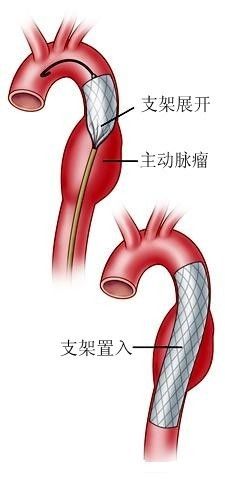 武汉亚洲心脏病医院 陈绪发 文章列表>主动脉夹层动脉瘤 主动脉夹层