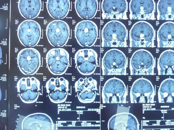     贺教授近期手术: 经前纵裂入路鞍结节脑膜瘤全