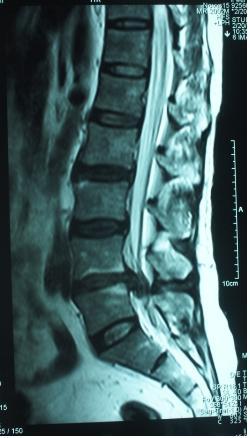 腰椎间盘突出症患者的最佳治疗方案---保守 微