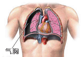 好大夫在线 陈应泰 什么是肺大泡?它是怎样引起自发性气胸的?