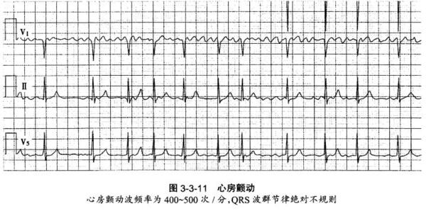 诊断:房颤的诊断以心电图为确诊依据,如阵发性房颤,动态心电图有助于