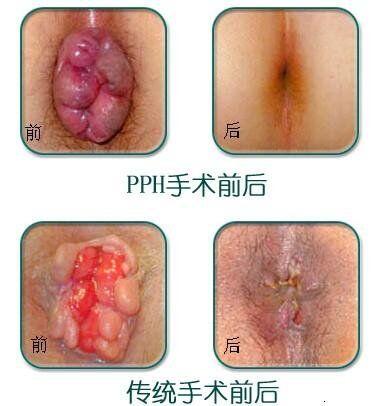 痔疮的微创治疗---PPH手术