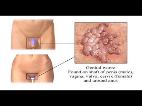 什么是阴茎珍珠疹