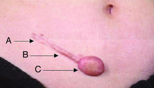 瘢痕分类_瘢痕疙瘩_瘢痕疙瘩症状 - 好大夫在线
