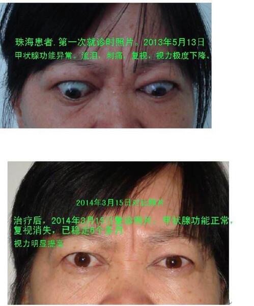 重症甲亢突眼怎么治疗突眼典型病例治疗前后照片对照图