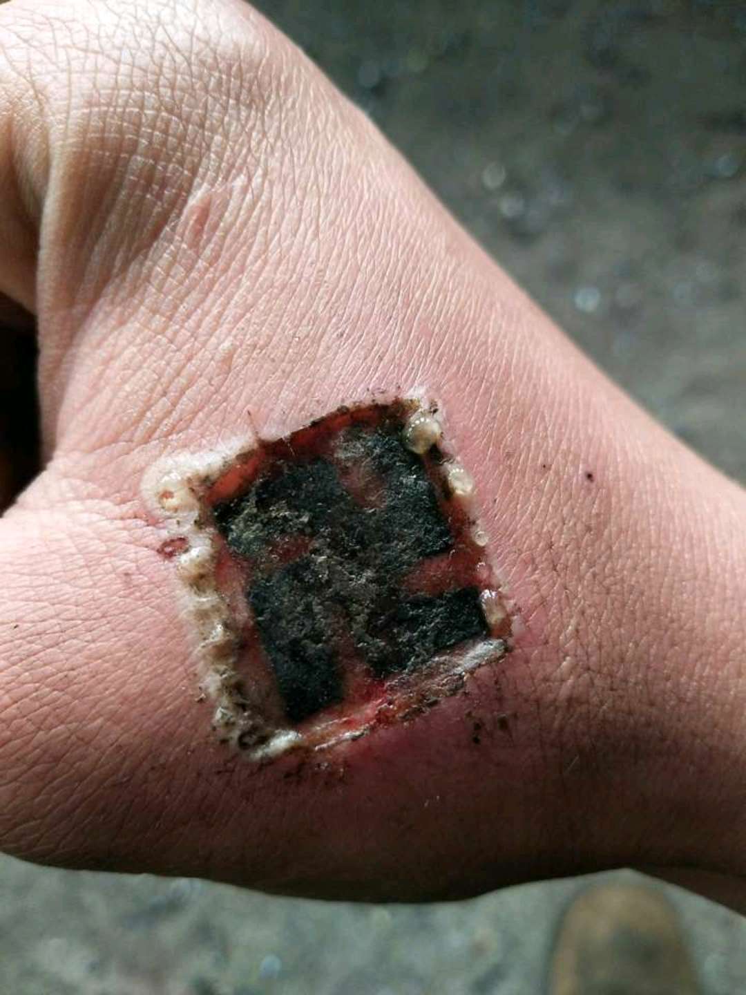 祛除纹身,何种方法更靠谱?