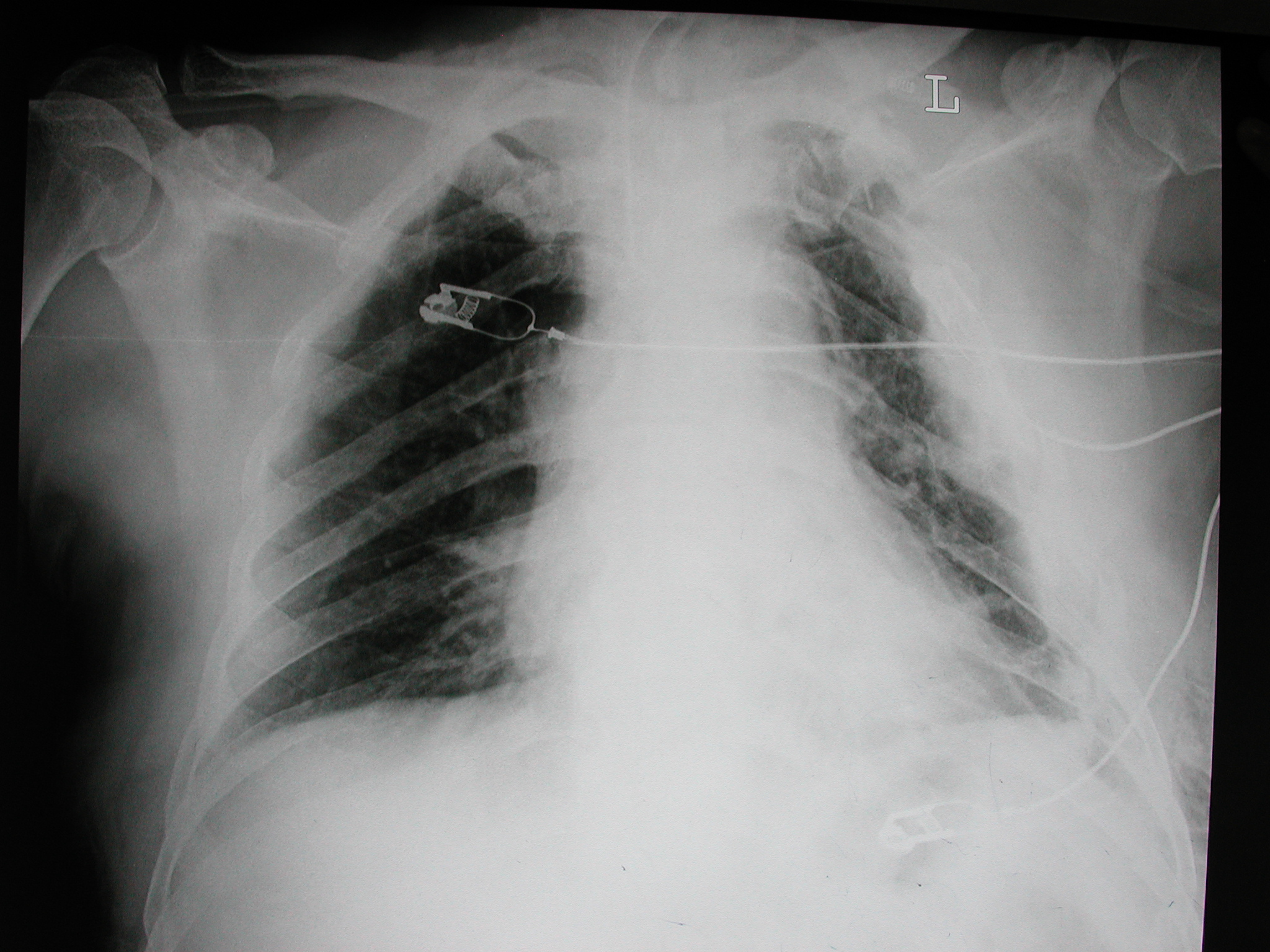 胸腔积液:与一位胸腔积液患者的对话