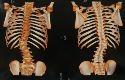 脊柱侧弯典型病例6_先天性脊柱侧弯-半椎体畸形