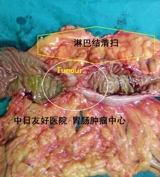 微创:四孔腹腔镜横结肠癌根治术(横结肠切除 淋巴结