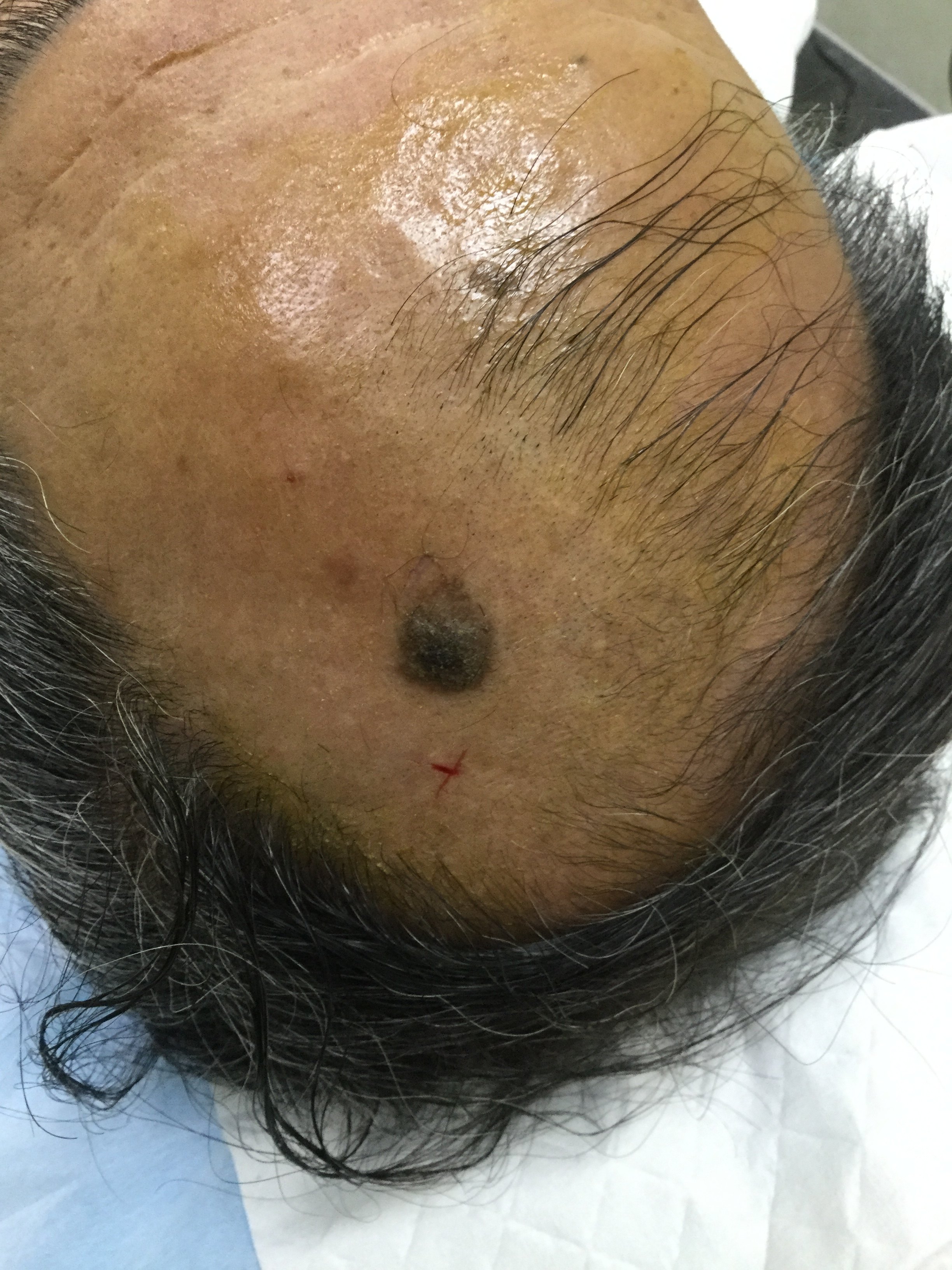 脂溢性角化病 www.haodf.com