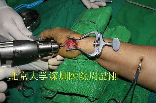 第一腕掌关节炎的手术治疗(附手术过程图片)