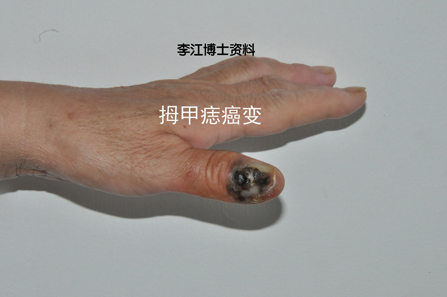 甲母痣的诊断和治疗