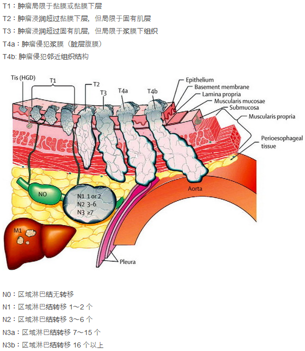 胃癌,结肠癌的tnm分期 (转载)