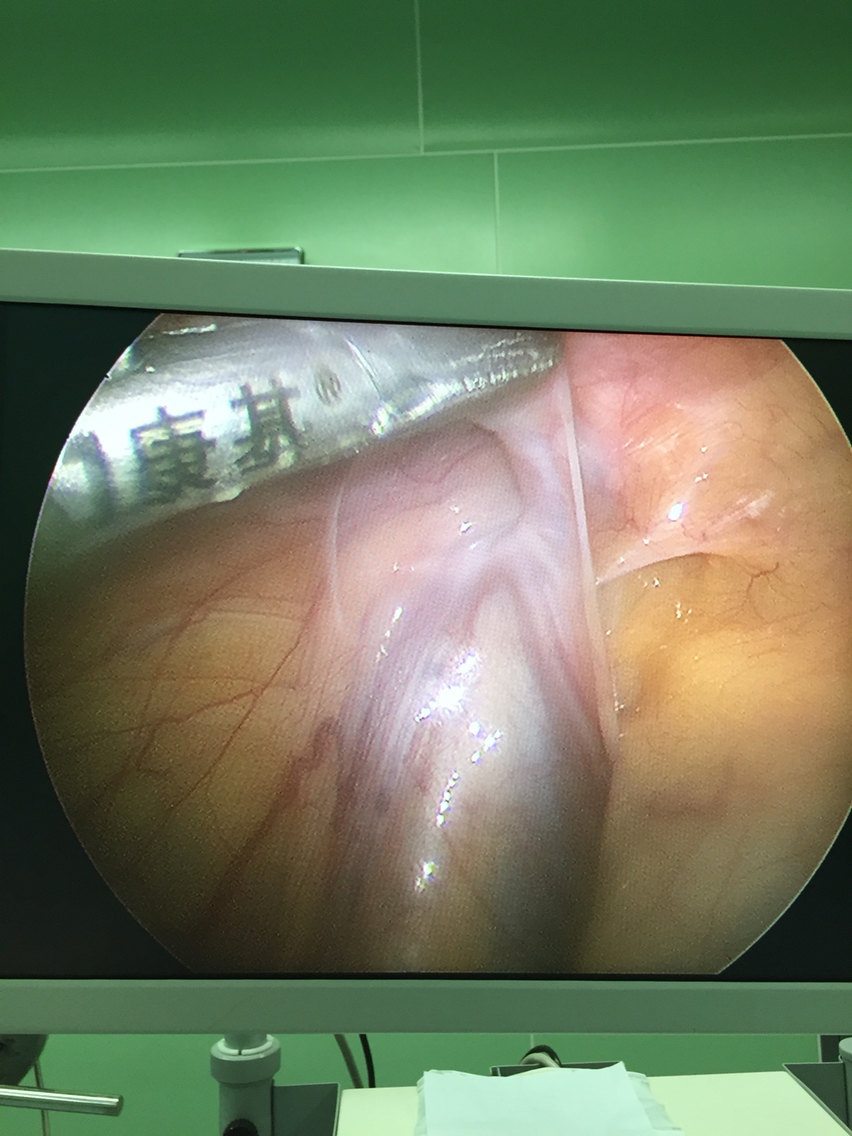 小儿腹股沟斜疝的微创治疗