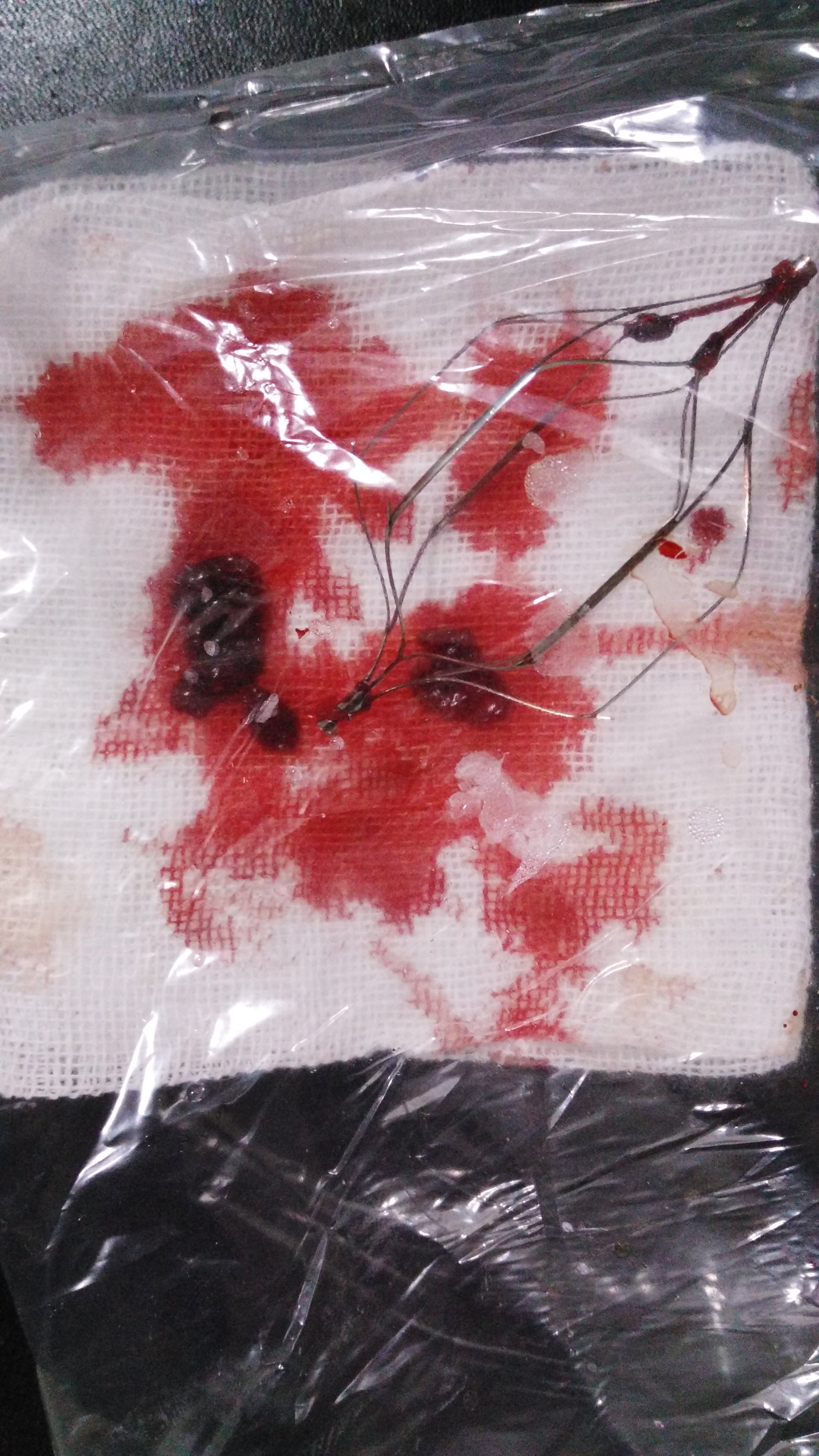 下腔静脉滤器~静脉血栓患者的生命保险