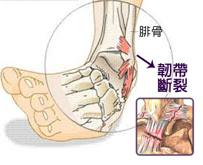 踝关节韧带损伤不容忽视