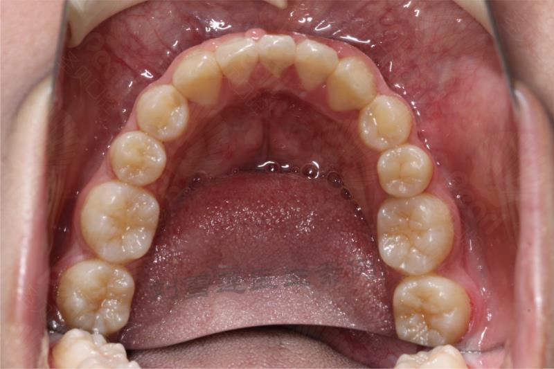 牙齿矫正病例分析—牙列不齐,深覆合深覆盖,畸形过小牙