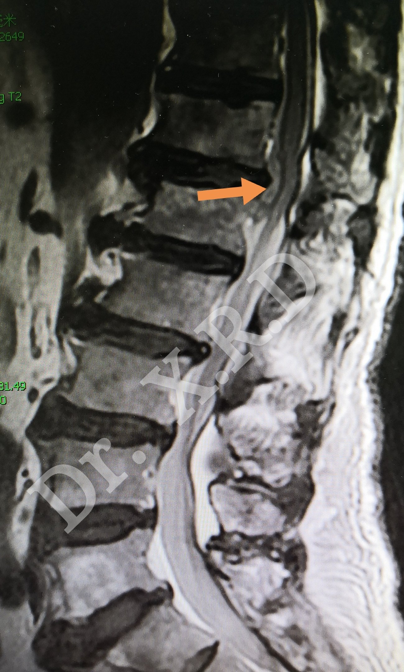术前磁共振矢状位显示胸12腰1椎间盘髓核脱出,压迫脊髓